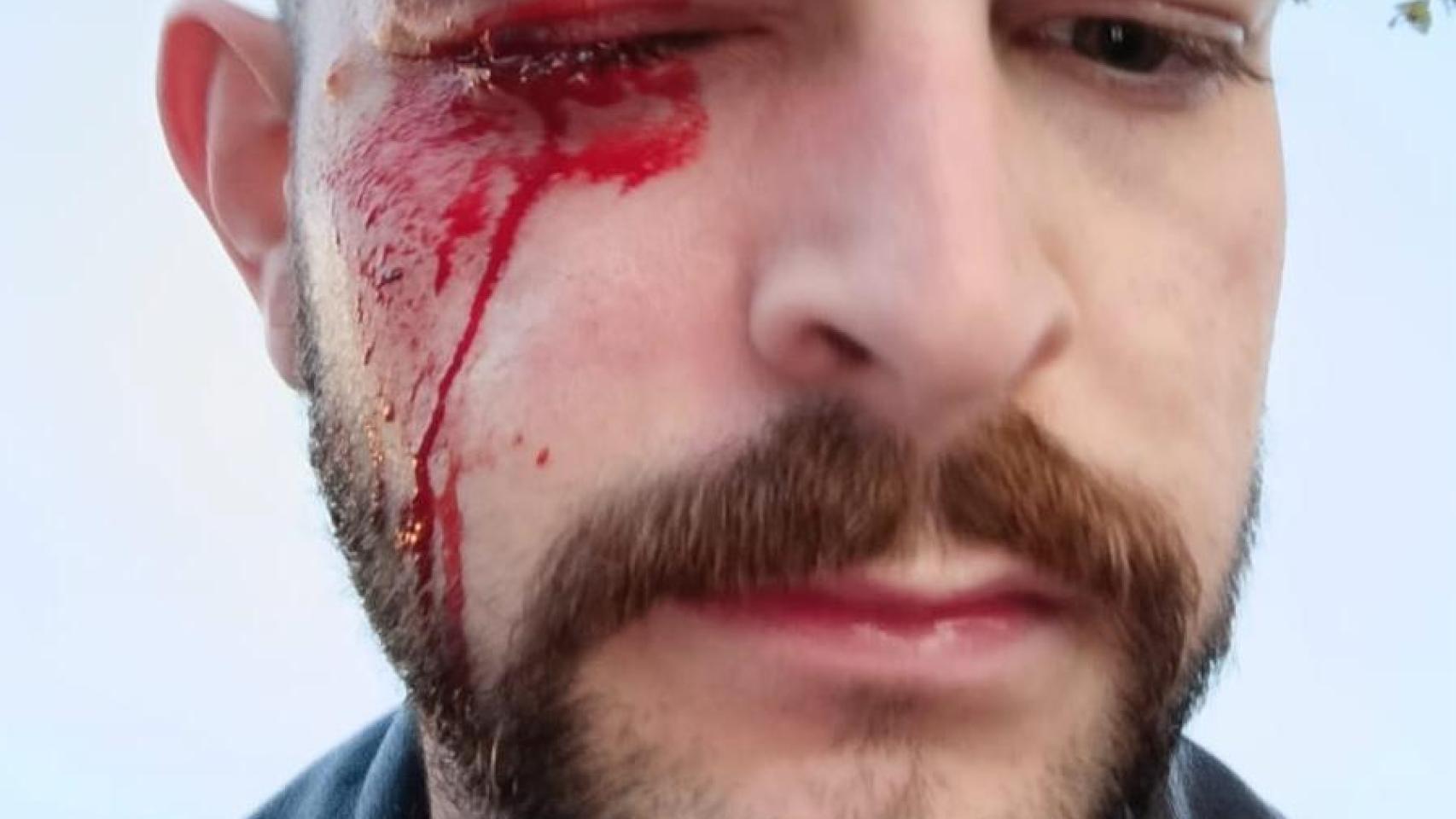 José Ismael Martínez, periodista de EL ESPAÑOL, tras la agresión sufrida en Pamplona.
