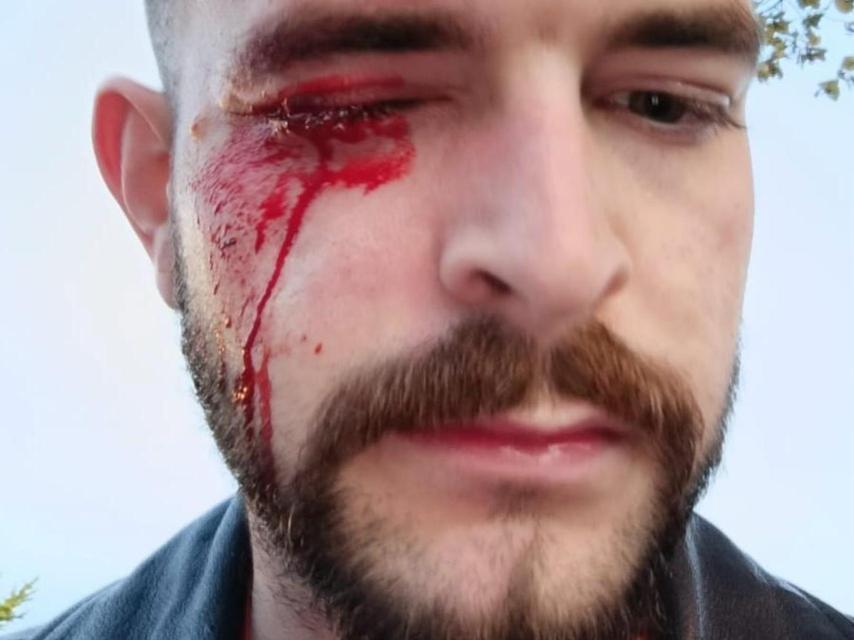 José Ismael Martínez, tras la agresión sufrida en Pamplona.