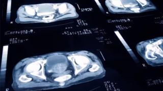 En España se espera que haya 32.188 nuevos casos de cáncer de próstata este año.