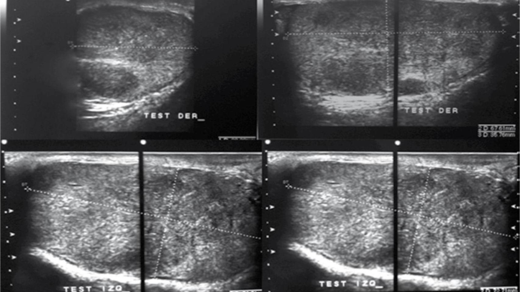 Ecografía de un tumor testicular bilateral.