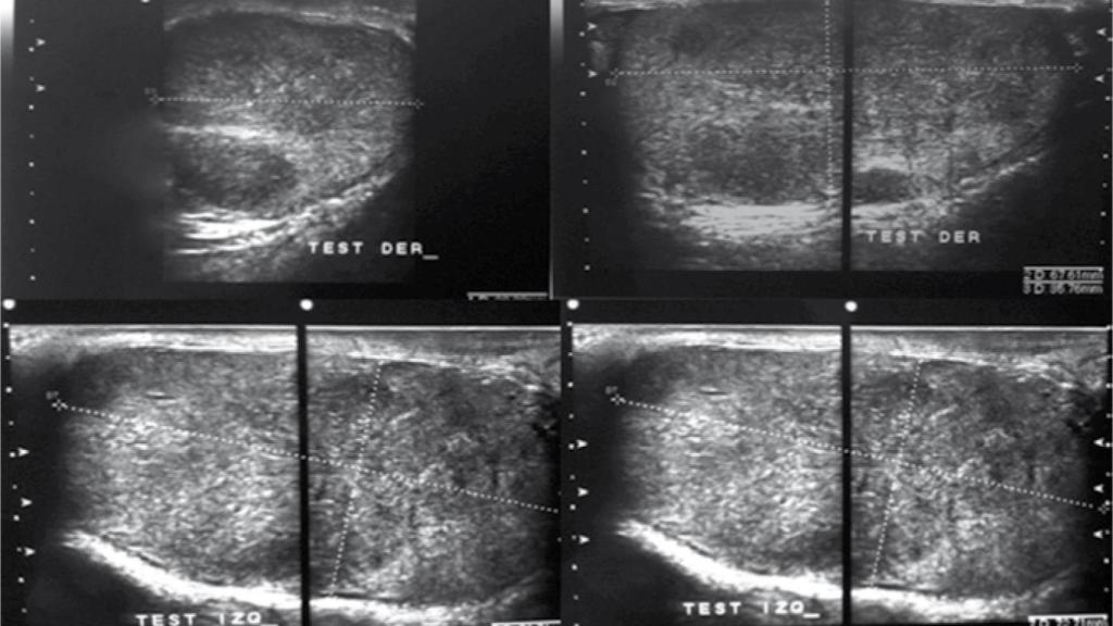 Ecografía de un tumor testicular bilateral.
