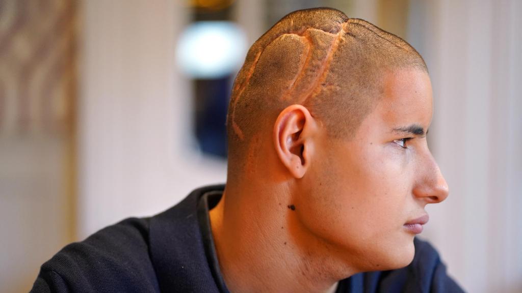 Cicatrices en la cabeza de Roque.