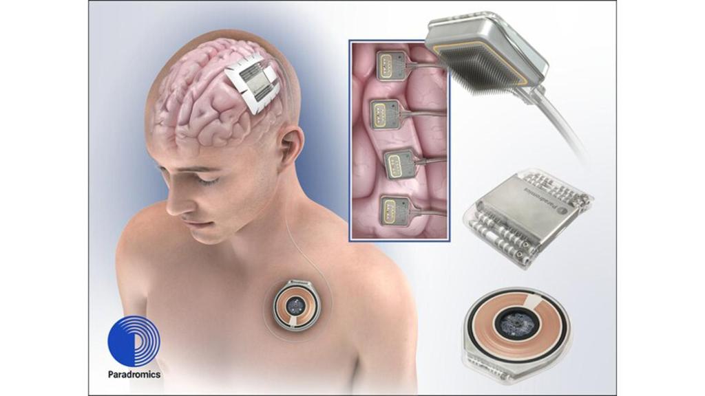 Infografía del implante.