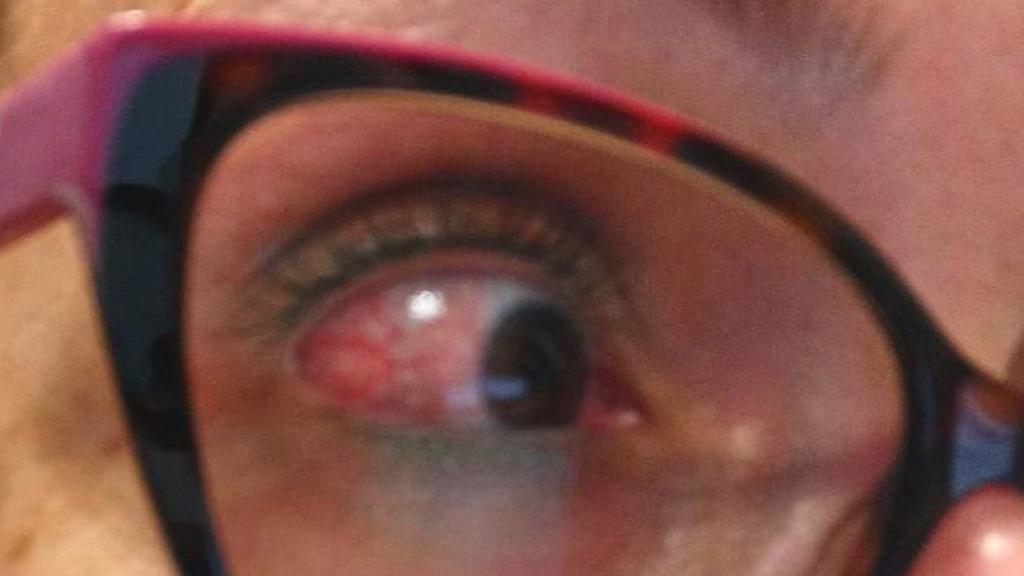 Una de las trabajadoras de los laboratorios con el ojo enrojecido.