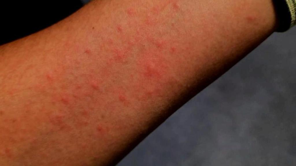 Erupción cutánea sufrida por uno de los técnicos.