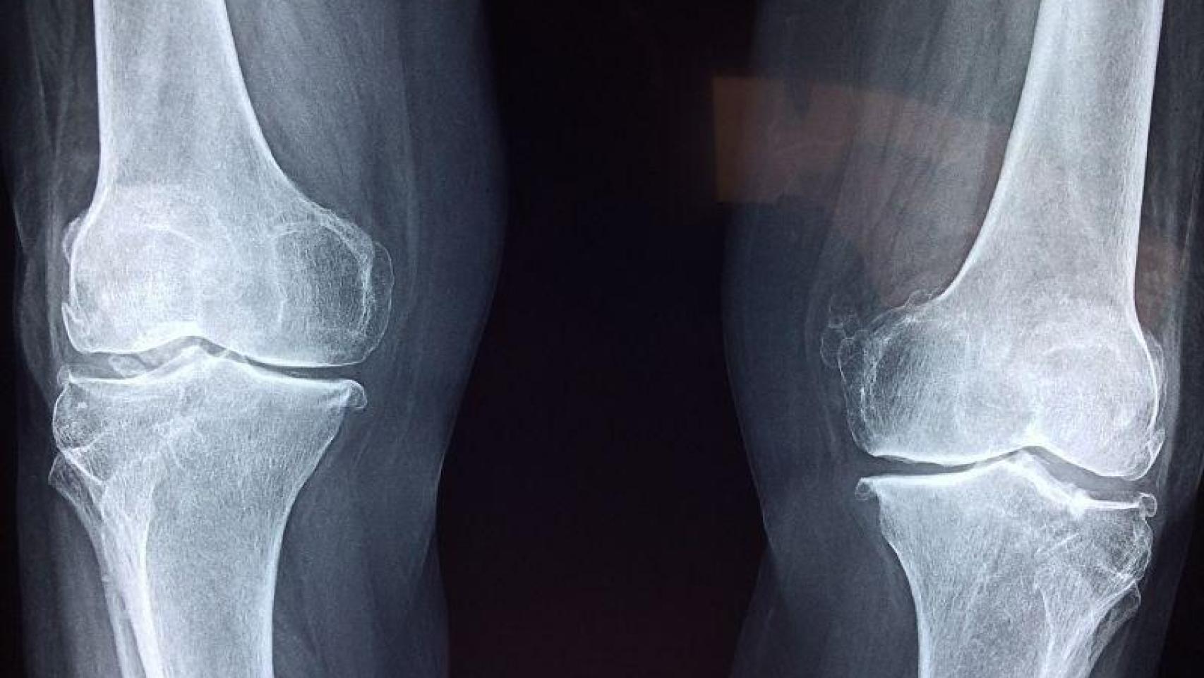 Hope for 7 Million Spaniards with Arthritis: Cartilage Regeneration in the Knee Achieved Through Injections
