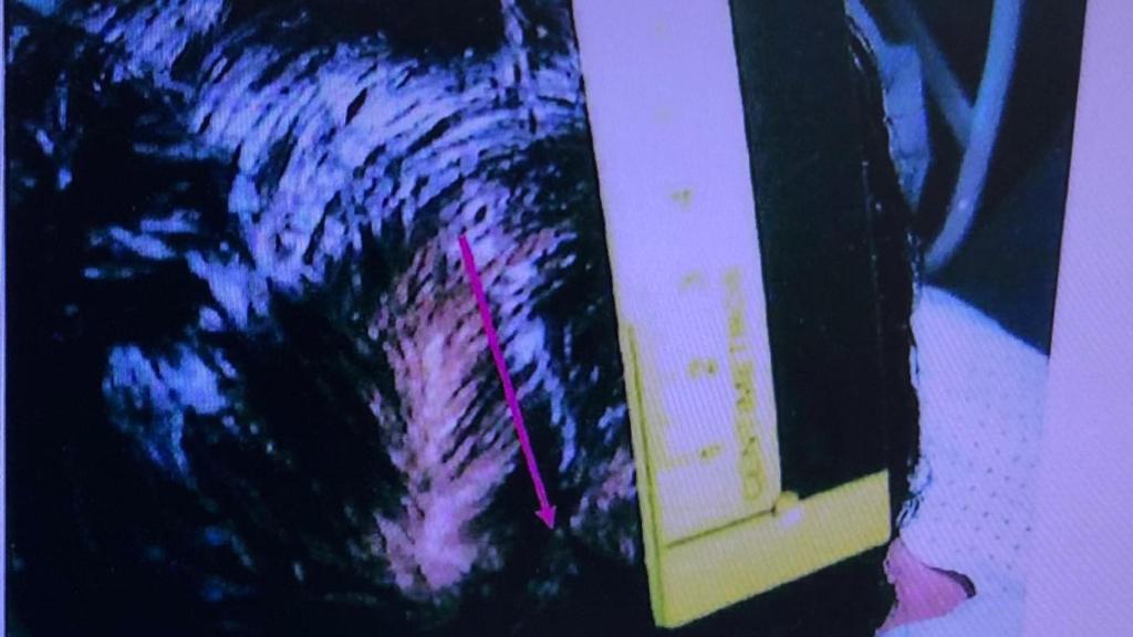 Lesões na cabeça de Juan Martinez.