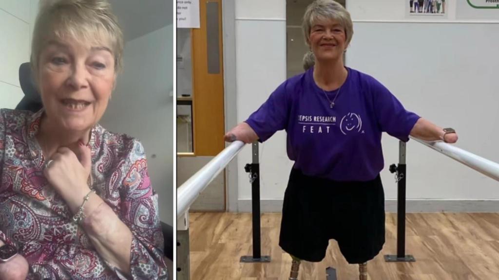 Kim con su nueva mano y, a la derecha, durante ejercicios de rehabilitación.