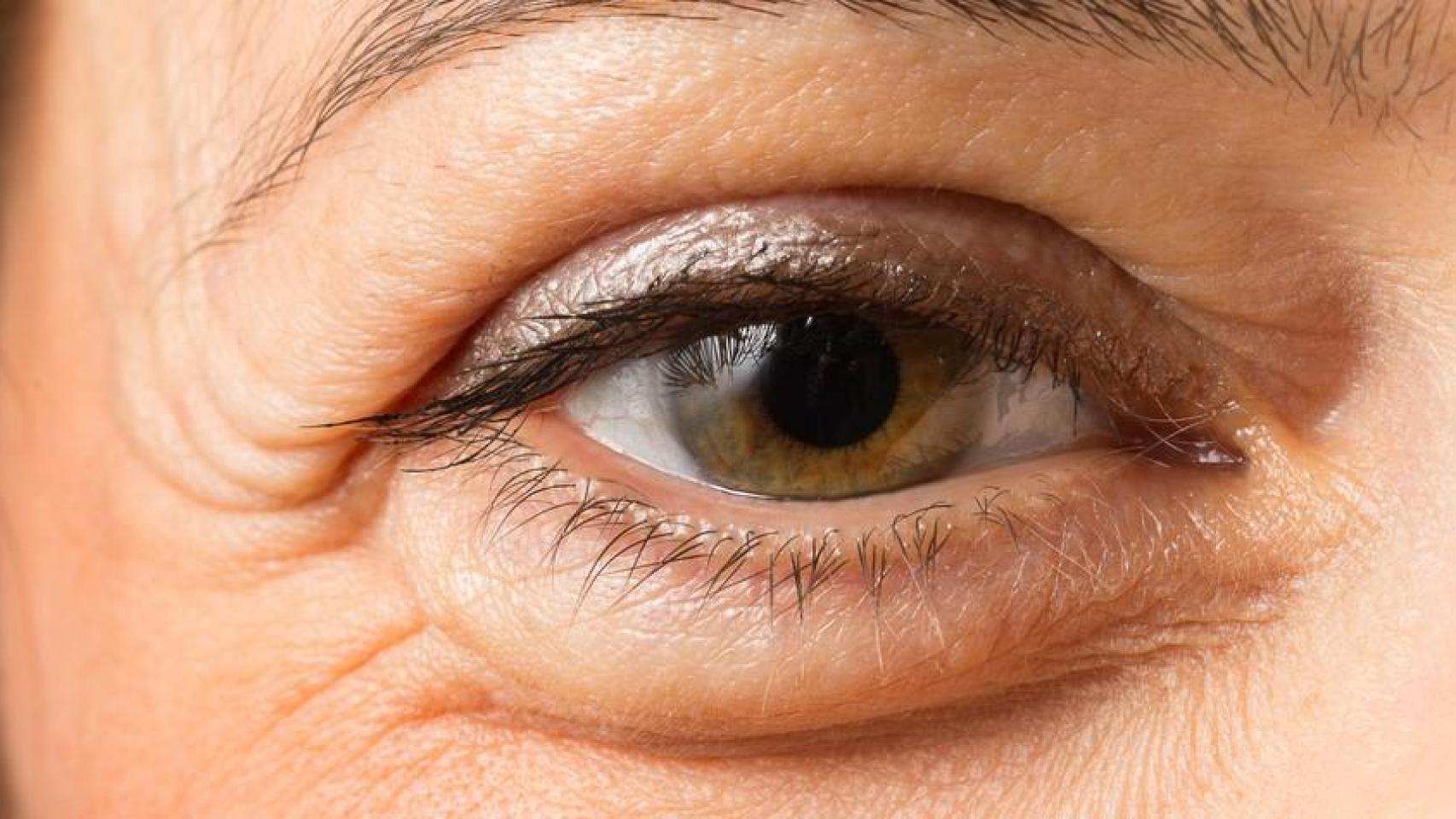 Mujer con bolsas en los ojos.