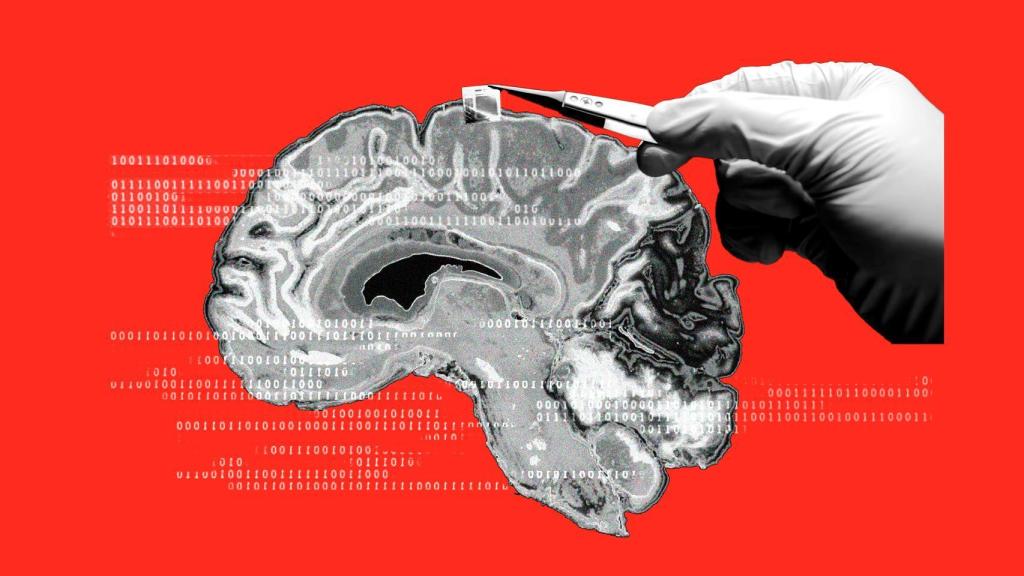 Ilustración con el implante cerebral BISC.