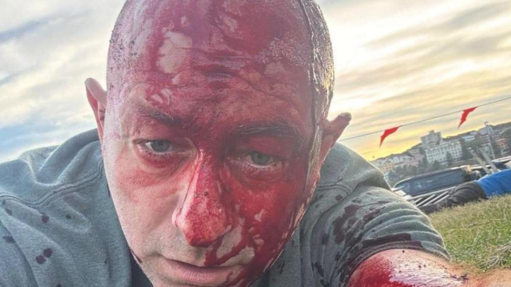 El abogado israelí herido en el ataque antisemita de Bondi Beach (Sídney) Arsen Ostrovsky.