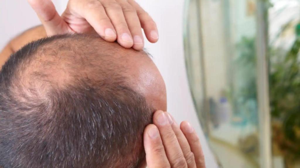 En la actualidad, se están desarrollando varias opciones de tratamiento prometedoras frente a la alopecia.