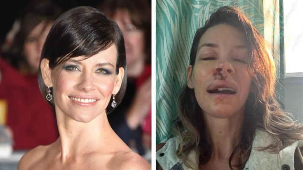 Evangeline Lilly ha confesado que tiene lesiones cerebrales tras la aparatosa caída que sufrió hace unos meses.