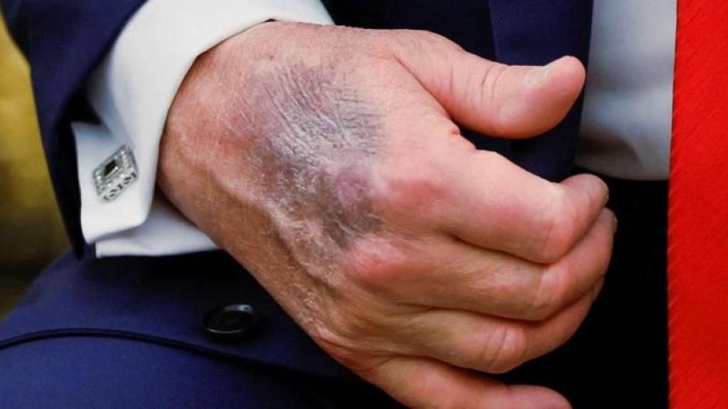 La mano de Donald Trump ha exhibido vistosos moretones en los últimos meses.