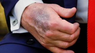 La mano de Donald Trump ha exhibido vistosos moretones en los últimos meses.