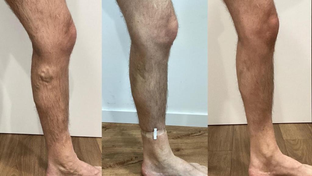 Antes/Después de Francisco, paciente de Varitek.