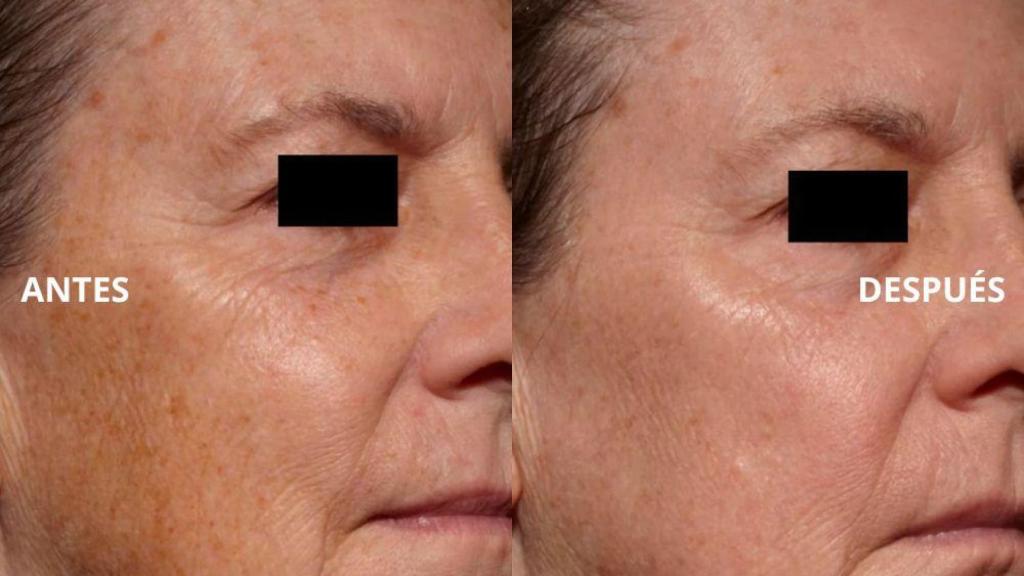 Beneficios de este láser facial antiedad en casa