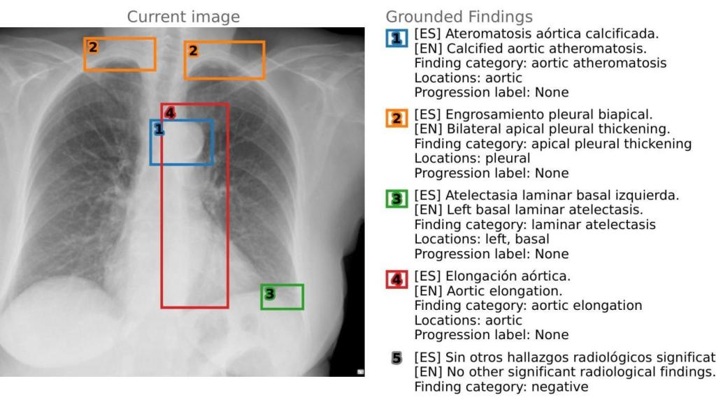 Ejemplo de informe generador por PadChest