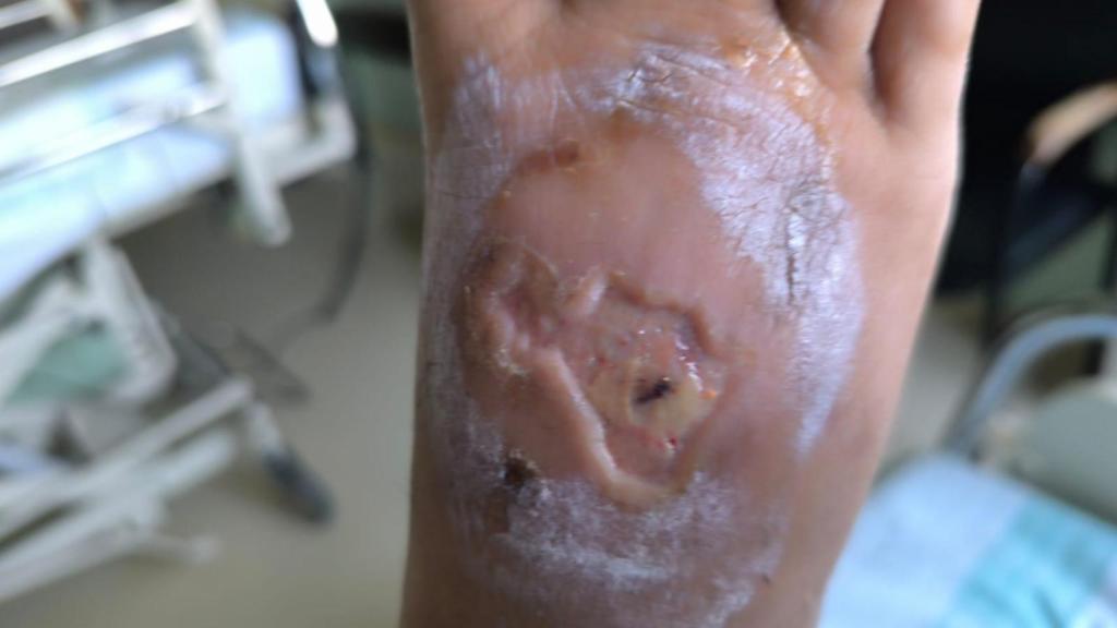 El pie de Antonia V. tras las quemaduras y los golpes.