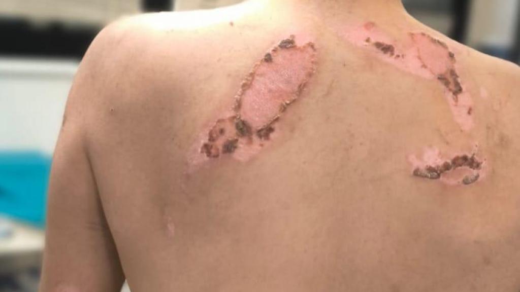 La espalda de Antonia V. tras las torturas.