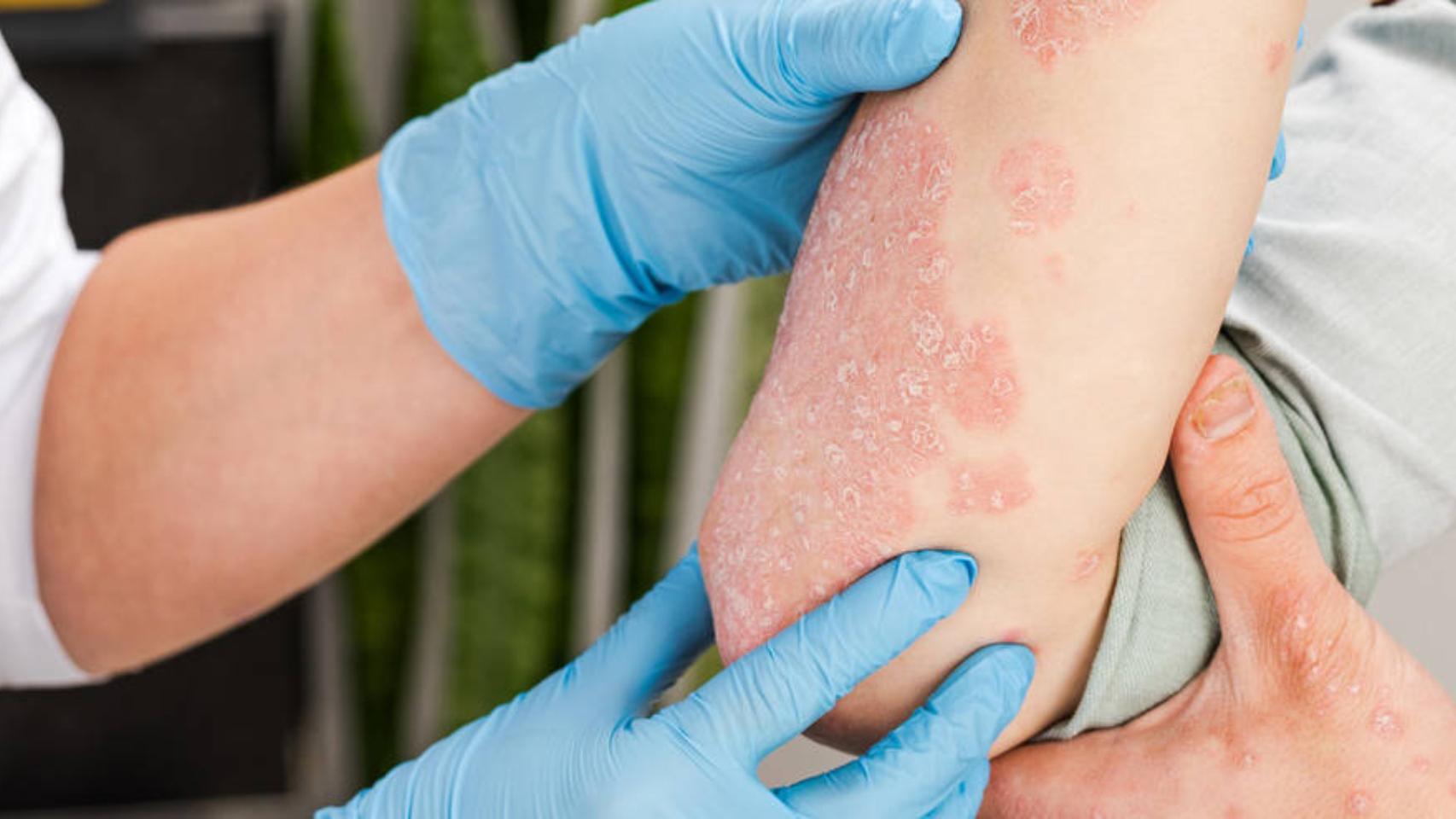La psoriasis es una enfermedad inflamatoria crónica para la que no existe cura actualmente.