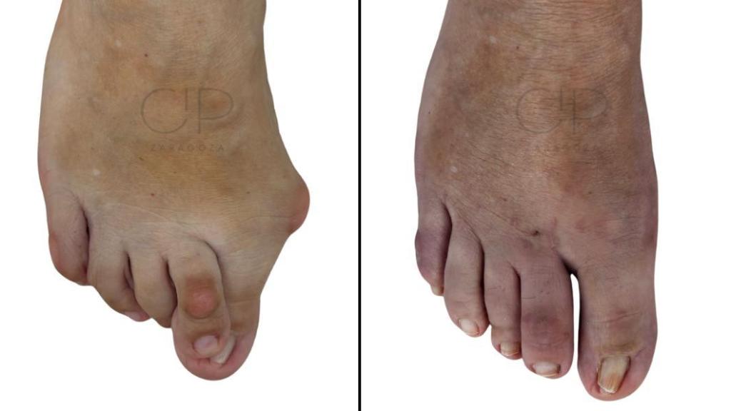 Antes y después en una intervención en CIP Zaragoza.