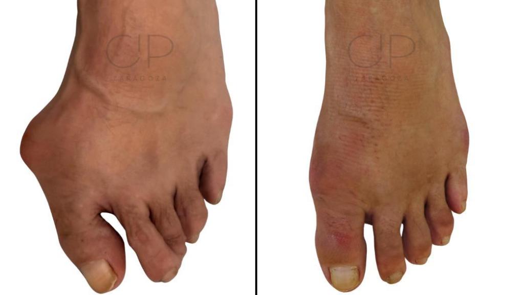 Antes y después en una intervención en CIP Zaragoza.