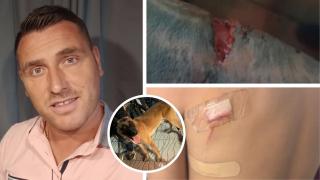 Iván, el héroe que auxilió a una madre y dos niños tras el ataque de un perro en Marbella; sus heridas, arriba; y la de un menor, abajo.