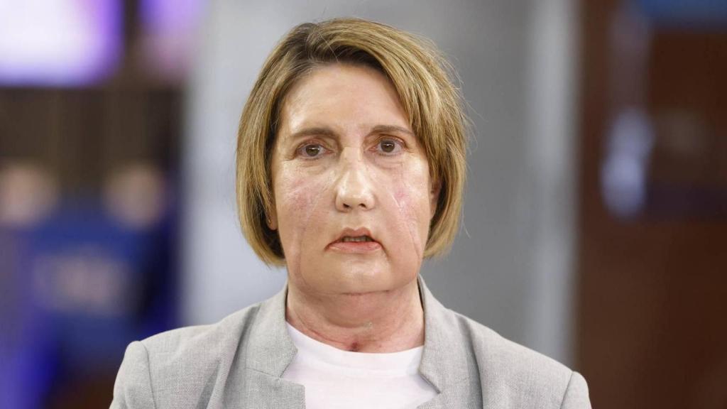 Carmen, la primera paciente en recibir un trasplante de cara de una donante que recibió una eutanasia