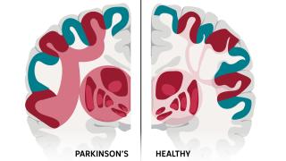 Ilustración de la red neuronal responsable del párkinson frente a un cerebro sano.