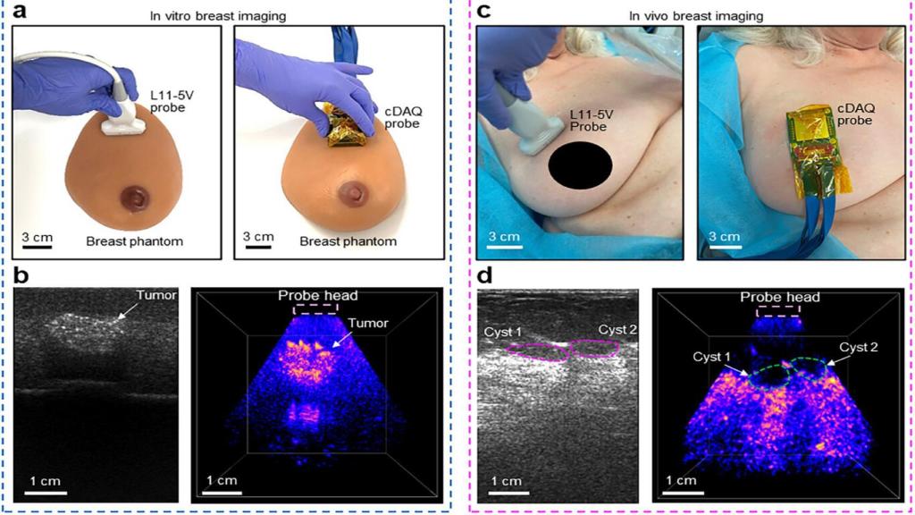 Esquema del funcionamiento del sensor de ultrasonido portátil para detectar el cáncer de mama.