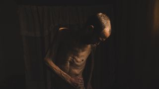 Un superviviente de las prisiones del régimen sirio muestra las huellas de la desnutrición y la tortura sufridas durante su encarcelamiento.