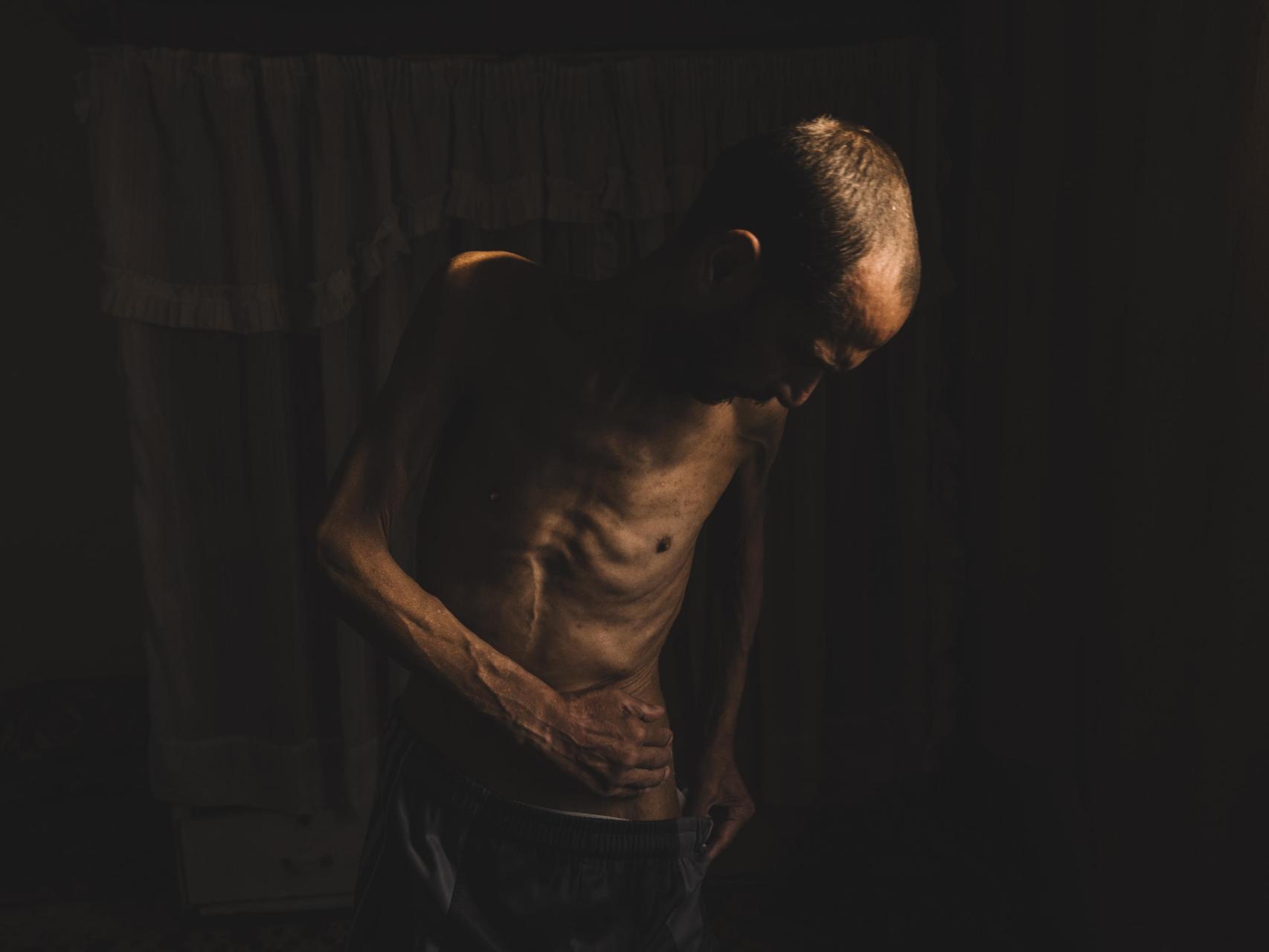 Un superviviente de las prisiones del régimen sirio muestra las huellas de la desnutrición y la tortura sufridas durante su encarcelamiento.