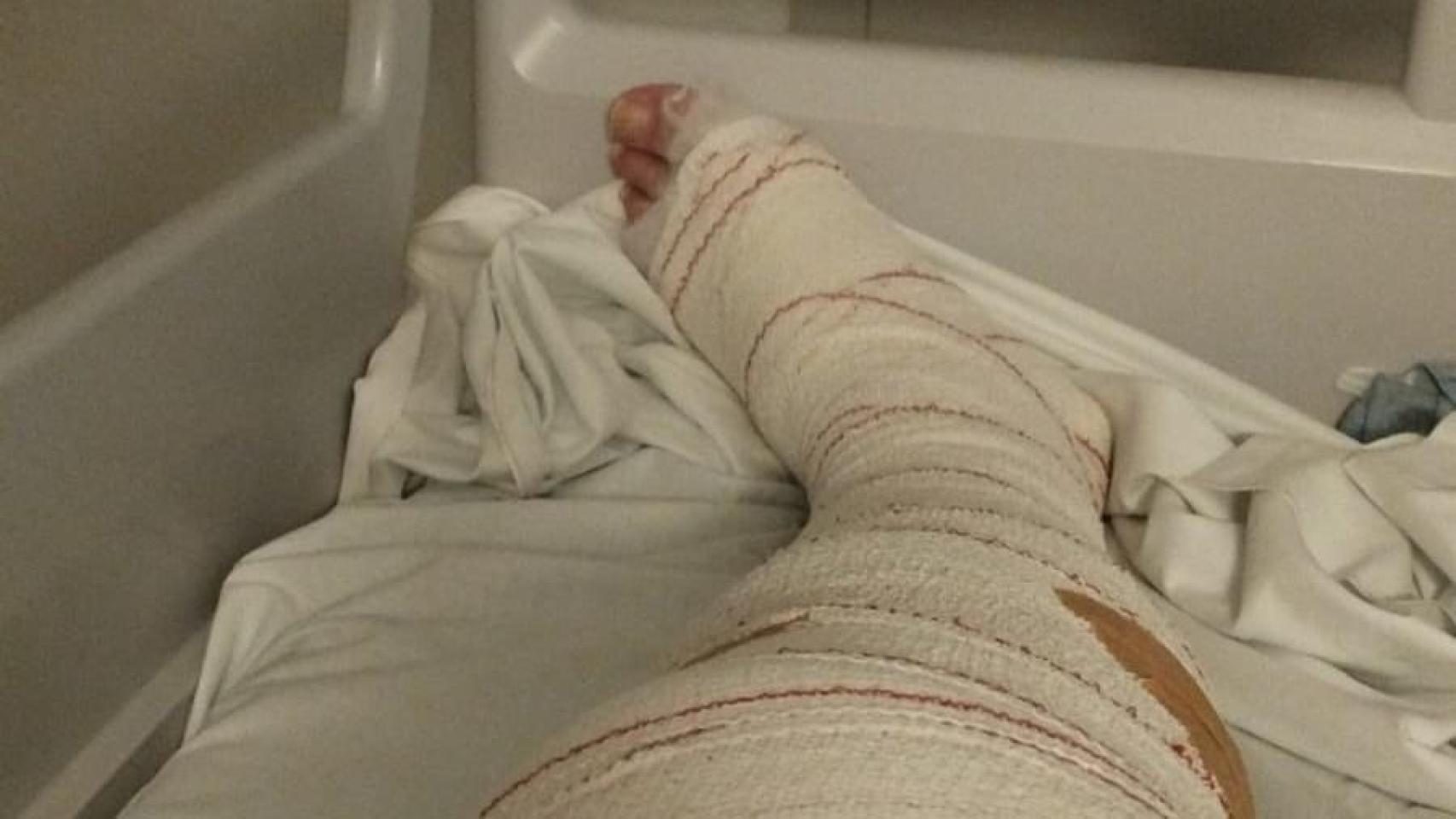 Imagen de la zona lesionada del funcionario.