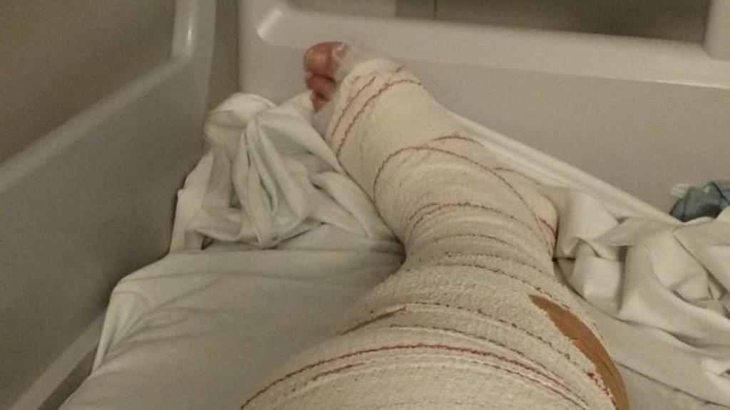 Imagen de la zona lesionada del funcionario.