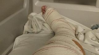 Imagen de la zona lesionada del funcionario.