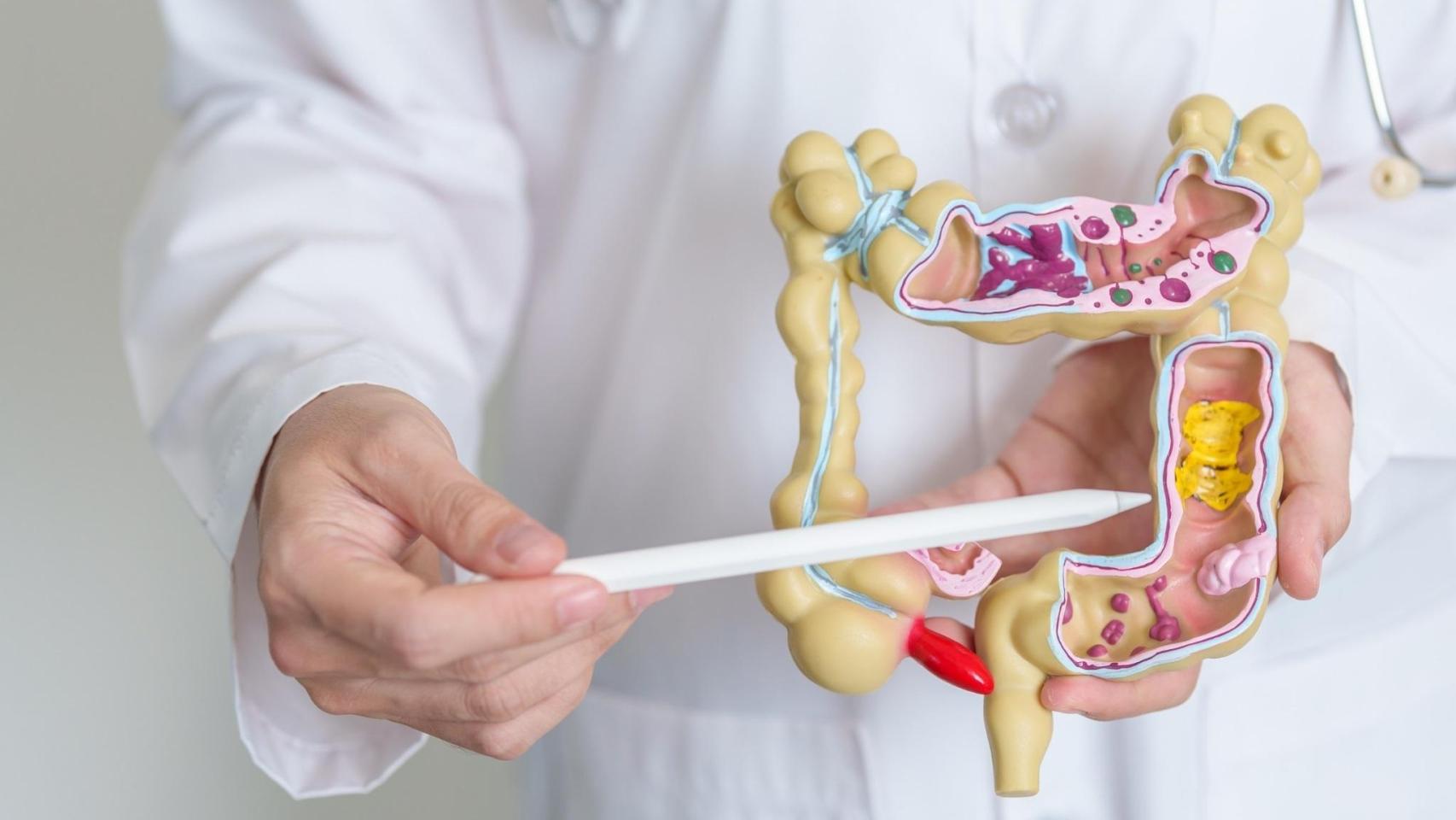 Enfermedad de Crohn o colitis ulcerosa.