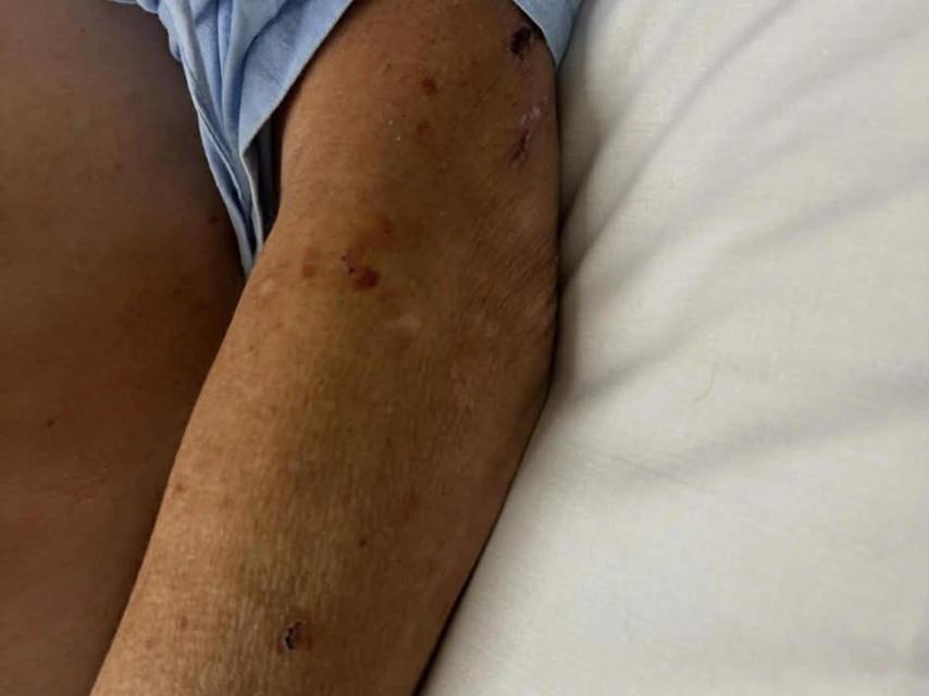 Heridas en el brazo de Gary a causa de los golpes y la violencia de los sospechosos.