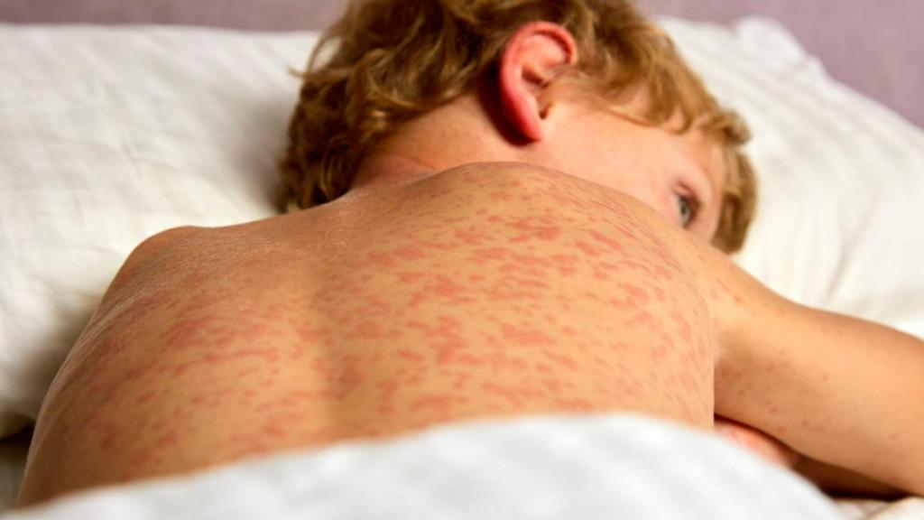 Imagen de archivo de un niño con exantemas en la piel, uno de los síntomas más reconocibles del sarampión.