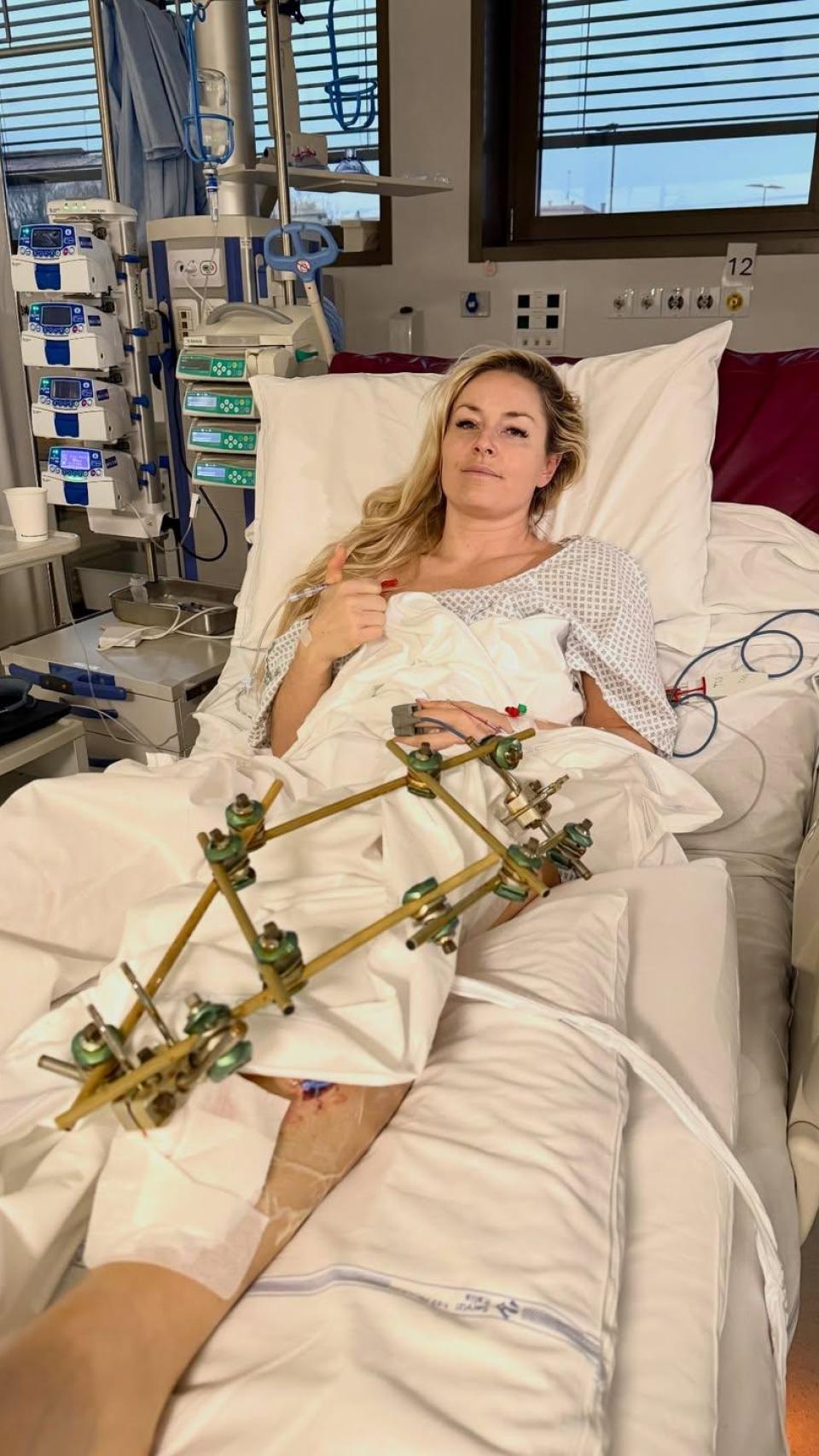 Lindsey Vonn sufrió una fractura compleja de tibia tras su accidente de esquí en los Juegos Olímpicos de Invierno Milán-Cortina.