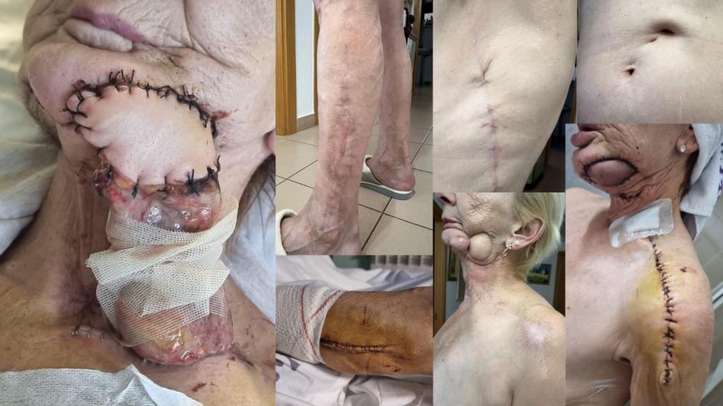 Las cicatrices de Yolanda Iturrospe tras sus operaciones.