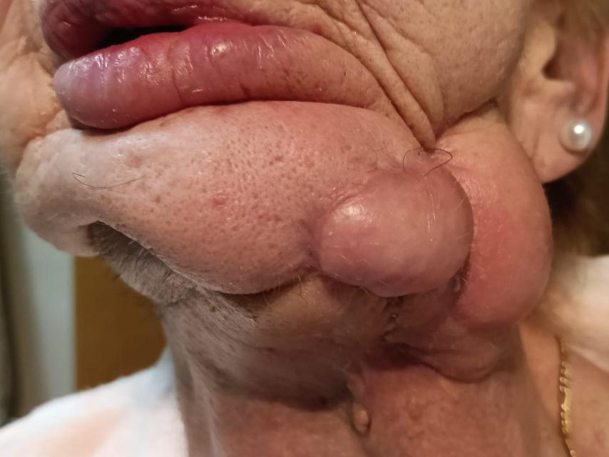 El estado actual de la mandíbula de Yolanda tras seis operaciones.