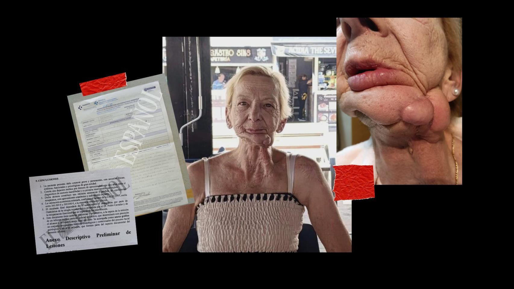 En el centro, Yolanda Iturrospe en la actualidad; a la derecha, el estado de su mandíbula tras las operaciones realizadas por necrosis; a la izquierda, la reclamación que interpuso la familia y el informe médico.