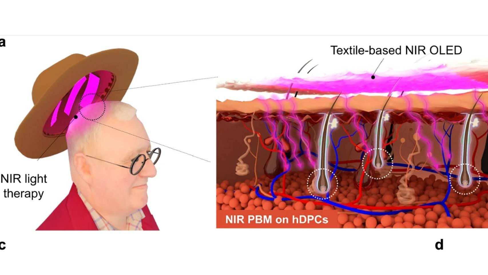 El 'wearable' NIR OLED y su efecto en los folículos. (Cho et al., Nat. Commun., 2026)