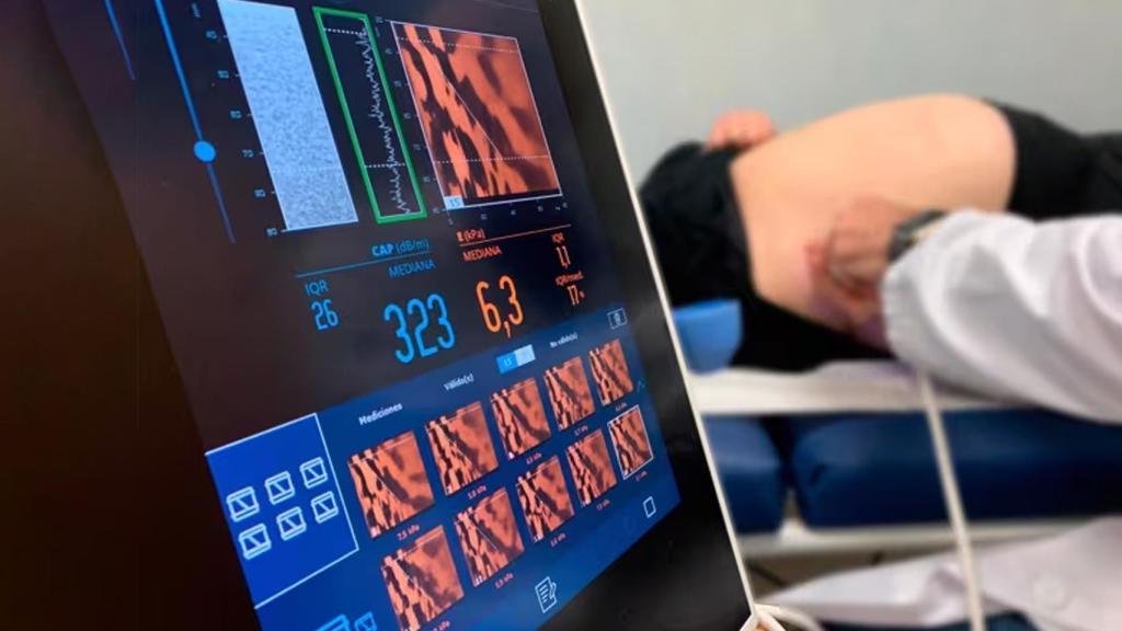 El 93% de los casos confirmados de enfermedad hepática crónica con fibrosis se deben a hígado graso.