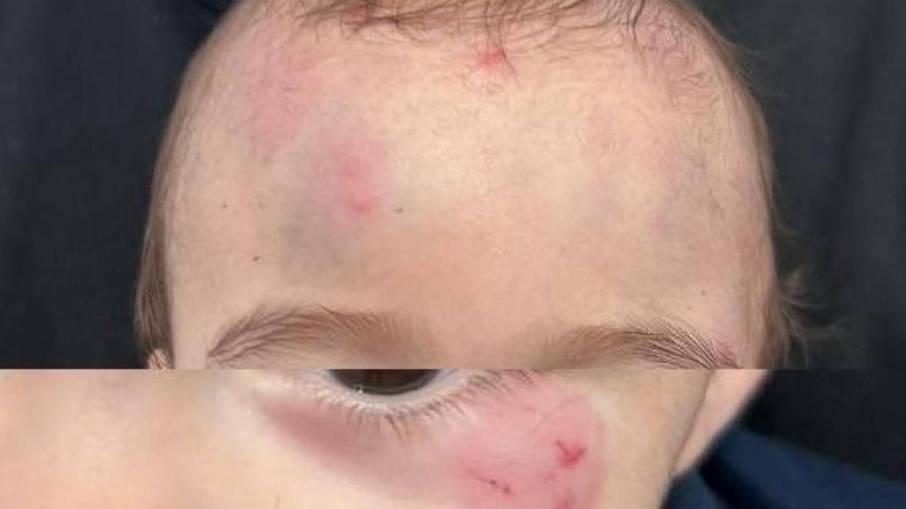 El menor cuyos padres denuncian las heridas sospechosas.