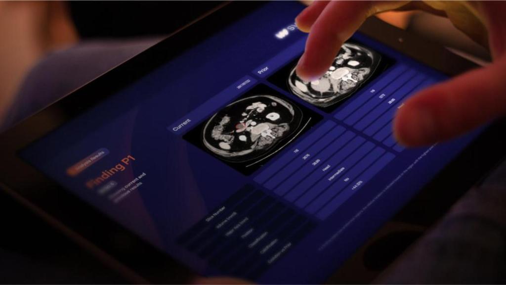 Software de Sycai para la detección de cáncer de páncreas