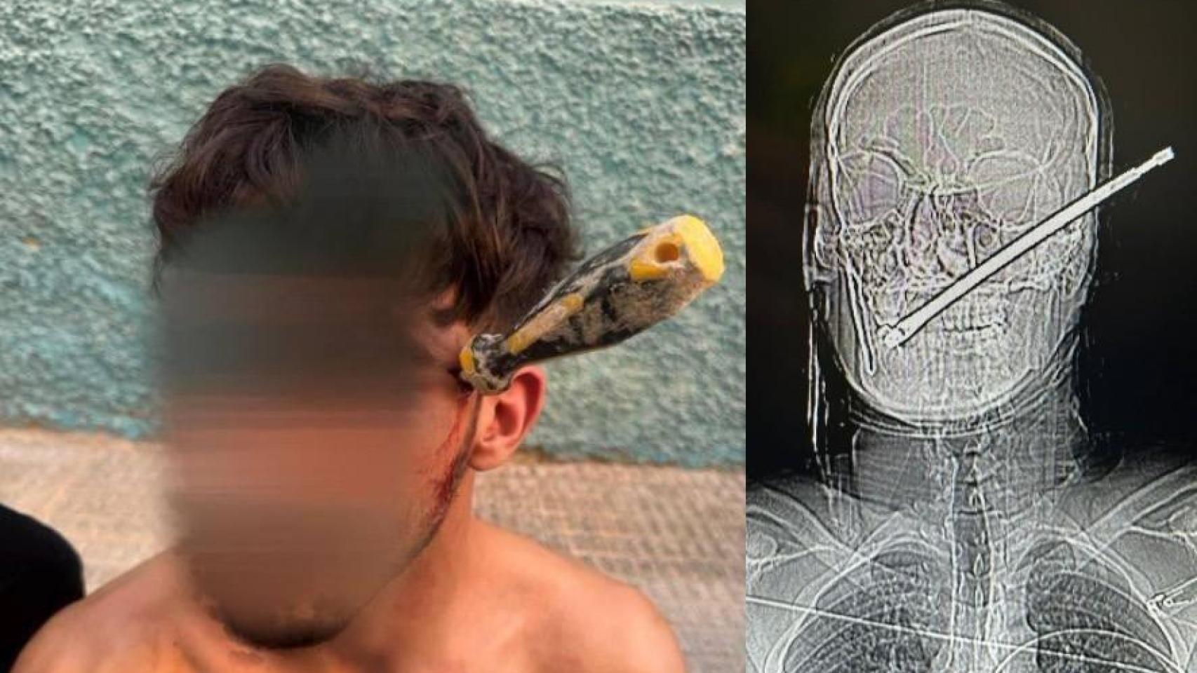 El veinteañero de Albatera al que le clavaron un destornillador en la cabeza y han salvado dos policías locales.