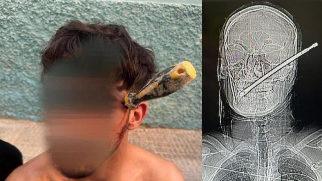 El veinteañero de Albatera al que le clavaron un destornillador en la cabeza y ha sido salvado por dos policías locales.