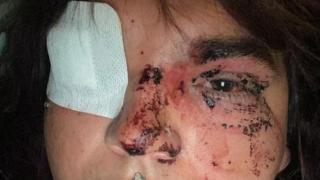 Bianca Lizbeth Fernández muestra sus secuelas tras la agresión